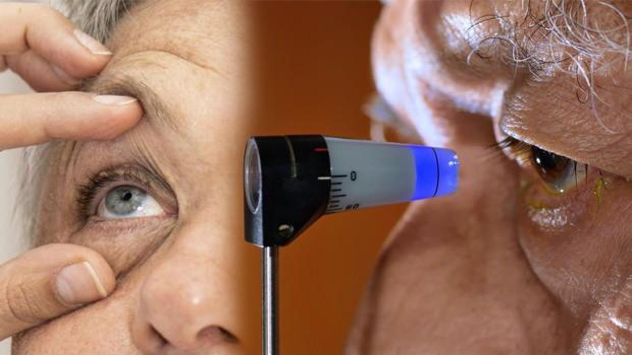 Göz tansiyonu olarak biliniyor, sinsi ilerliyor: Glokom hastalığı