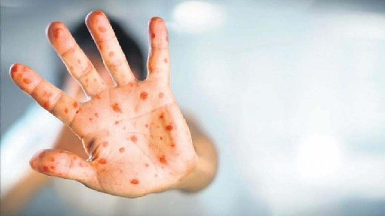 DSÖ, dünyadaki maymun çiçeği vaka sayısını açıkladı