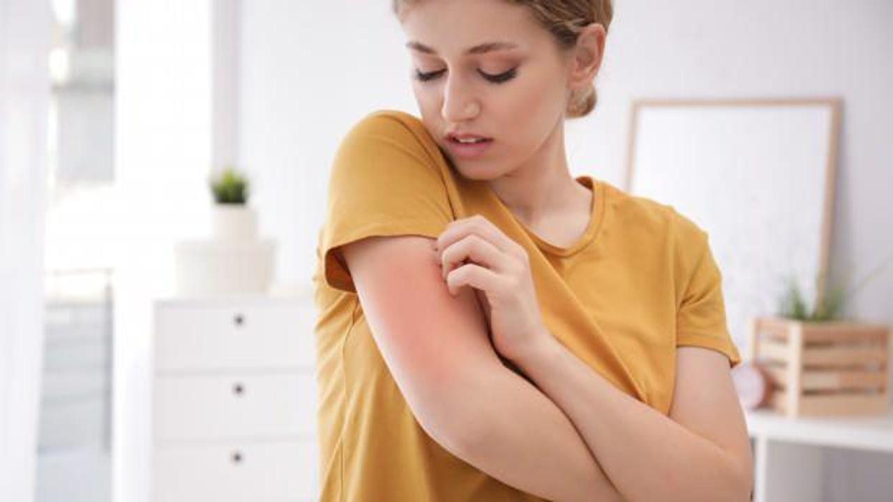 Enfeksiyonlar kurdeşene neden olabiliyor!