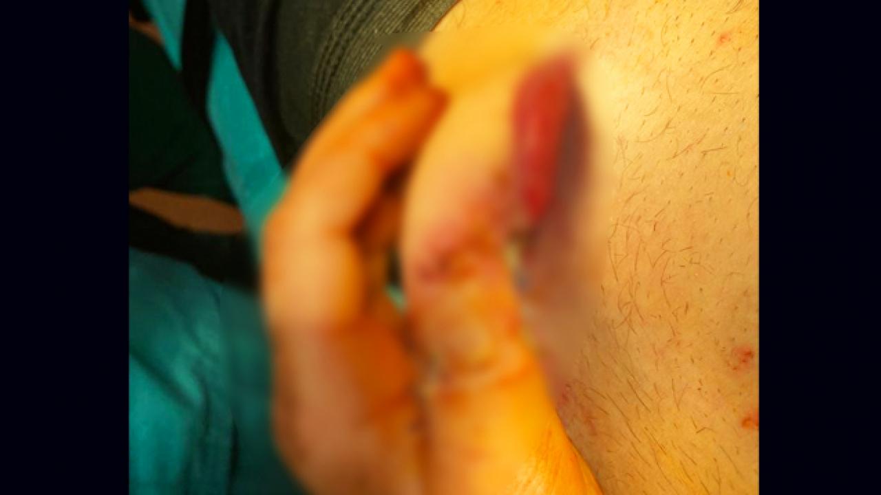 Kazada kopan parmağı, göbeğinde yeniden büyütüldü