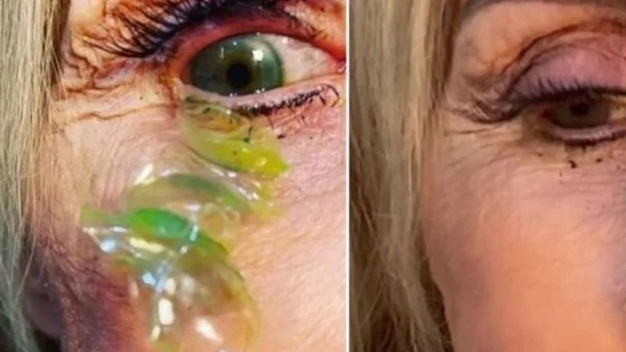 Lens takanlar dikkat! Hastanın gözünden çıkanlar şoke etti