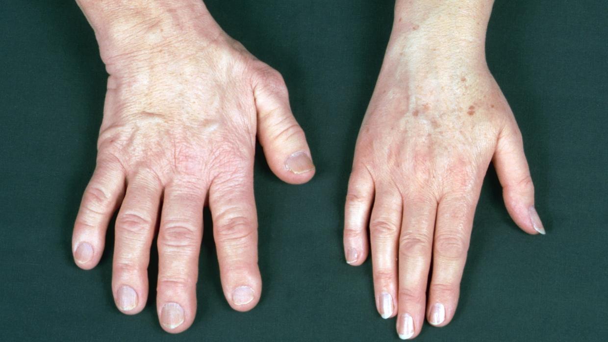 Nadir görülen ‘Akromegali’ hastalığına dikkat! Büyüme hastalığı olarak biliniyor