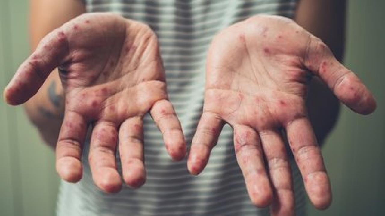 Dünya Sağlık Örgütü’nden umutlandıran maymun çiçeği öngörüsü