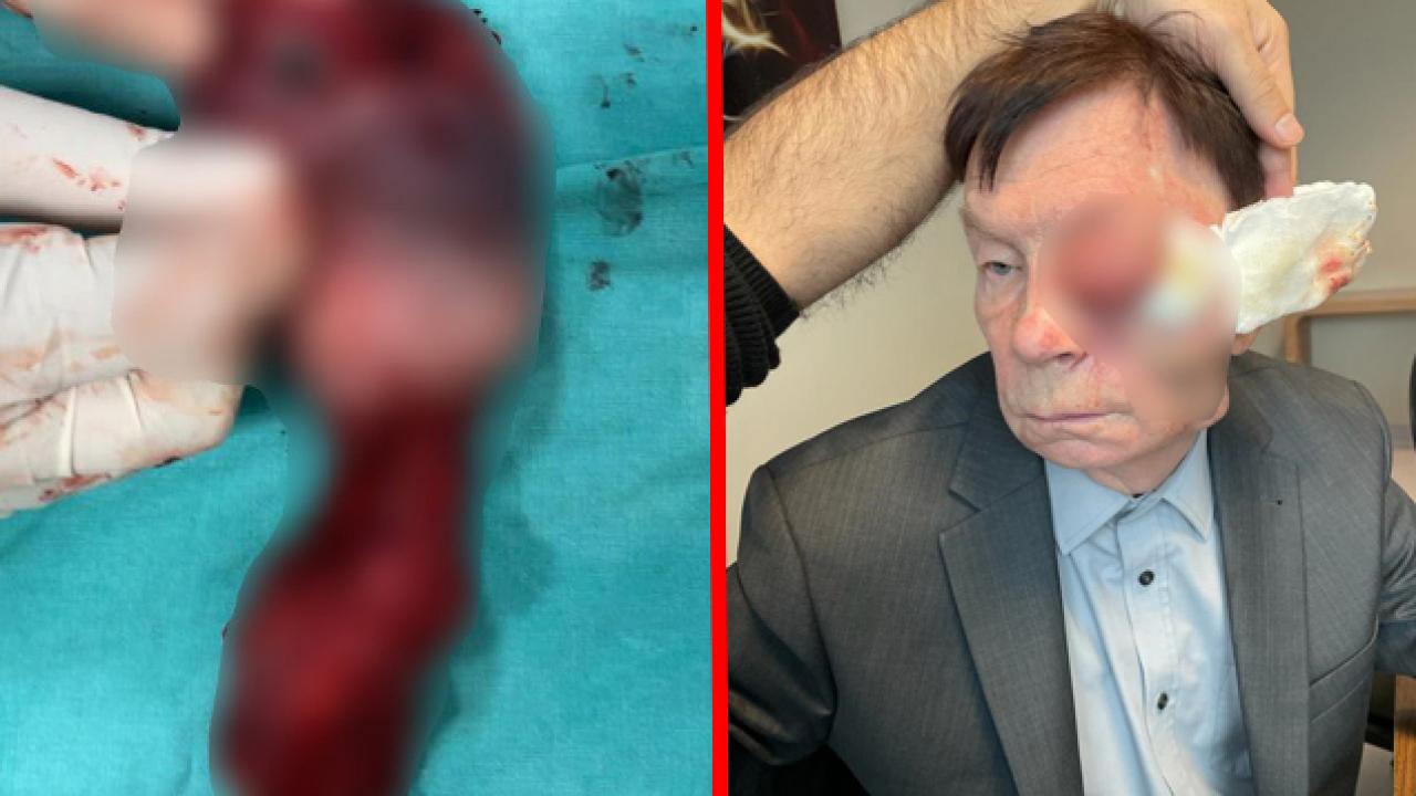 Ülkesinde ‘yaşamaz’ demişlerdi! Türkiye’ye geldi, yüzünden 2 yumruk tümör çıkarıldı