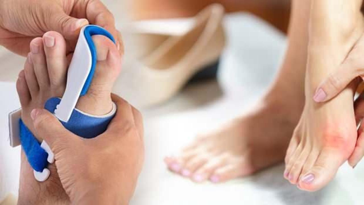 Yanlış ayakkabı seçimine dikkat! Kemik çıkıntısına neden oluyor