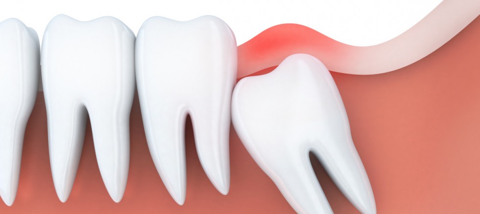 ‘Bütün gömülü dişlerin çekilmesi gerekmiyor’