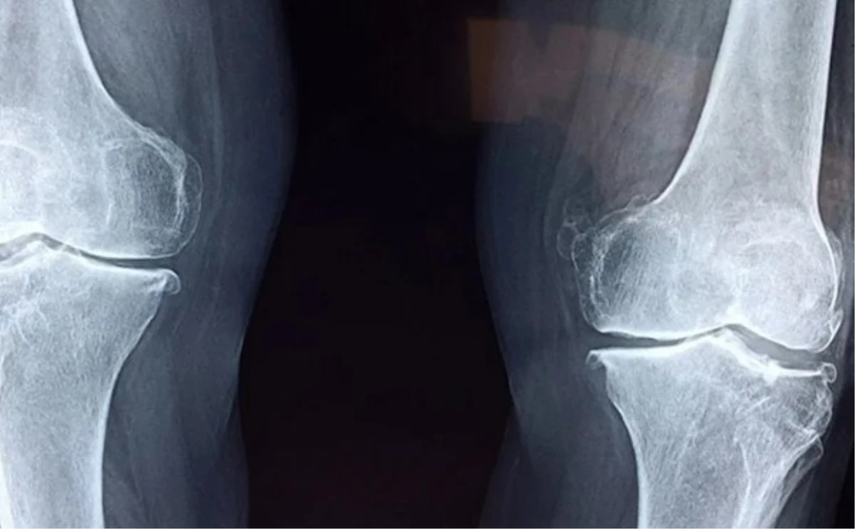 Katı kişi sendromu nedir? Katı kişi sendromu ne demek, neden olur?