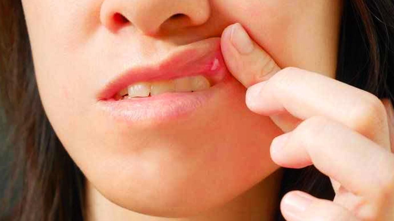 Dudakta uçuk neden çıkar? Tekrarlayan uçuk nasıl geçer?