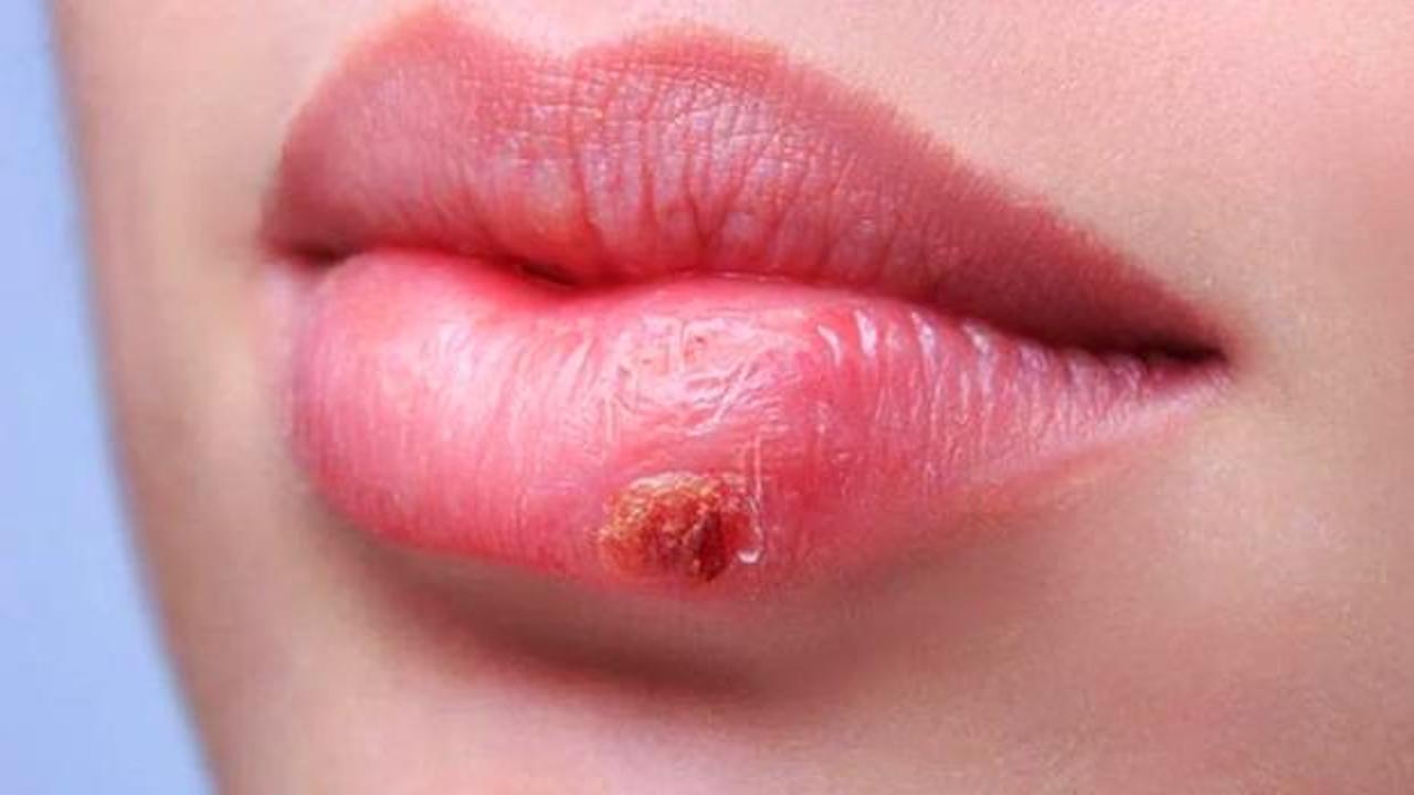 Dudakta uçuk neden çıkar?  Tekrarlayan uçuk nasıl geçer?