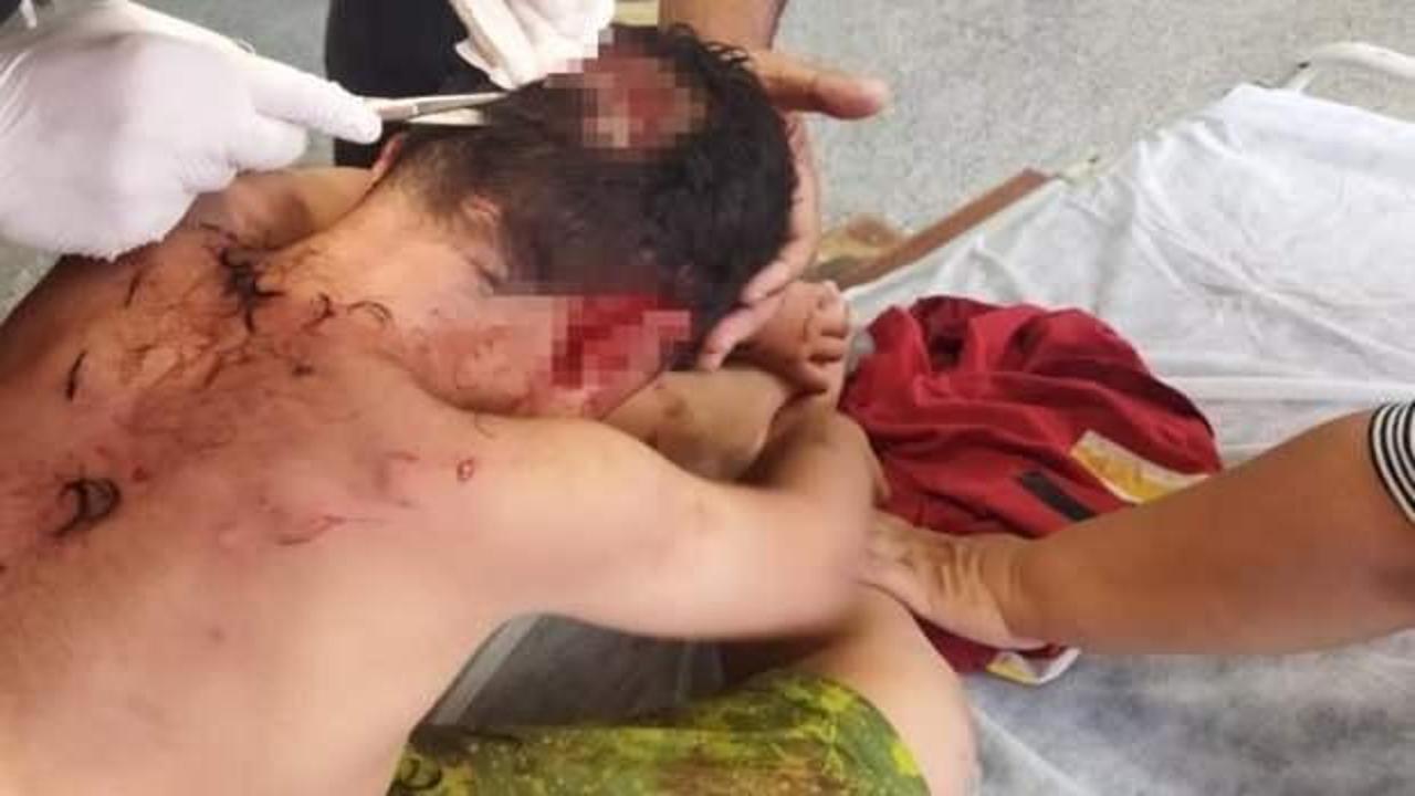 Bir köpek dehşeti daha! Çocuğun kafasına 25 dikiş atıldı…