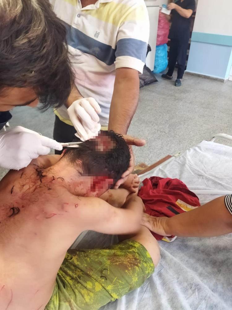 Bir köpek dehşeti daha! Çocuğun kafasına 25 dikiş atıldı...