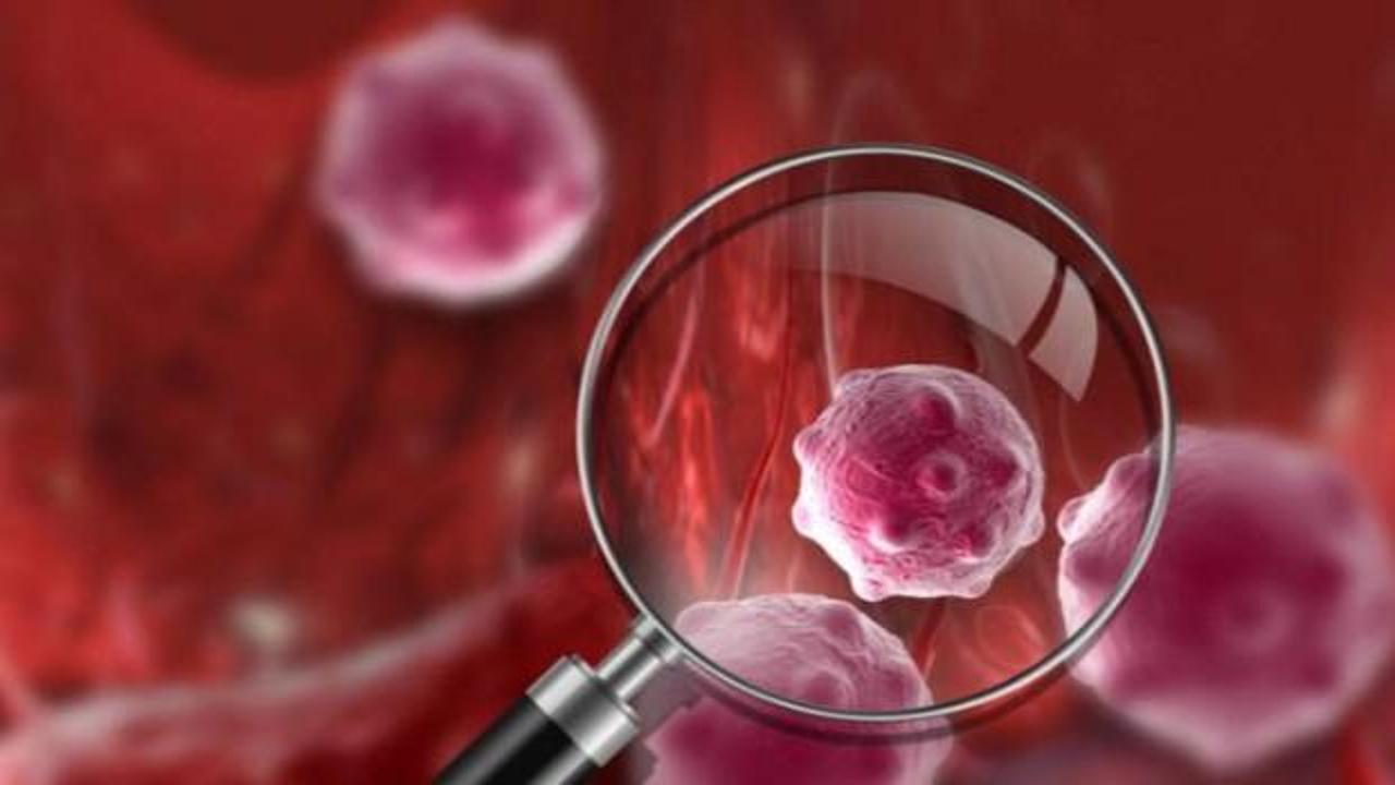 Miyeloid Lösemi nedir? Kronik Miyeloid Löseminin belirtileri