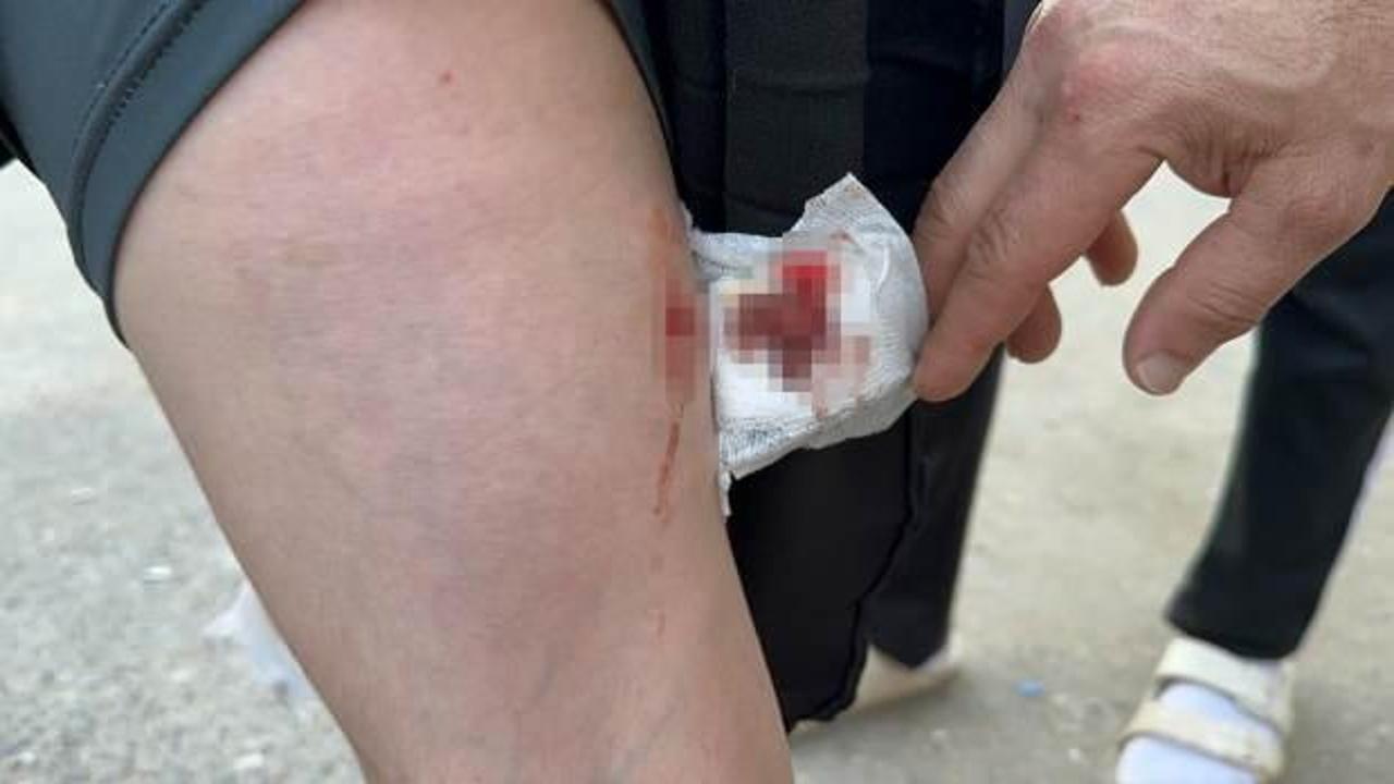 Sakarya’da 11 yaşındaki kız çocuğu sokak köpeğinin saldırısına uğradı