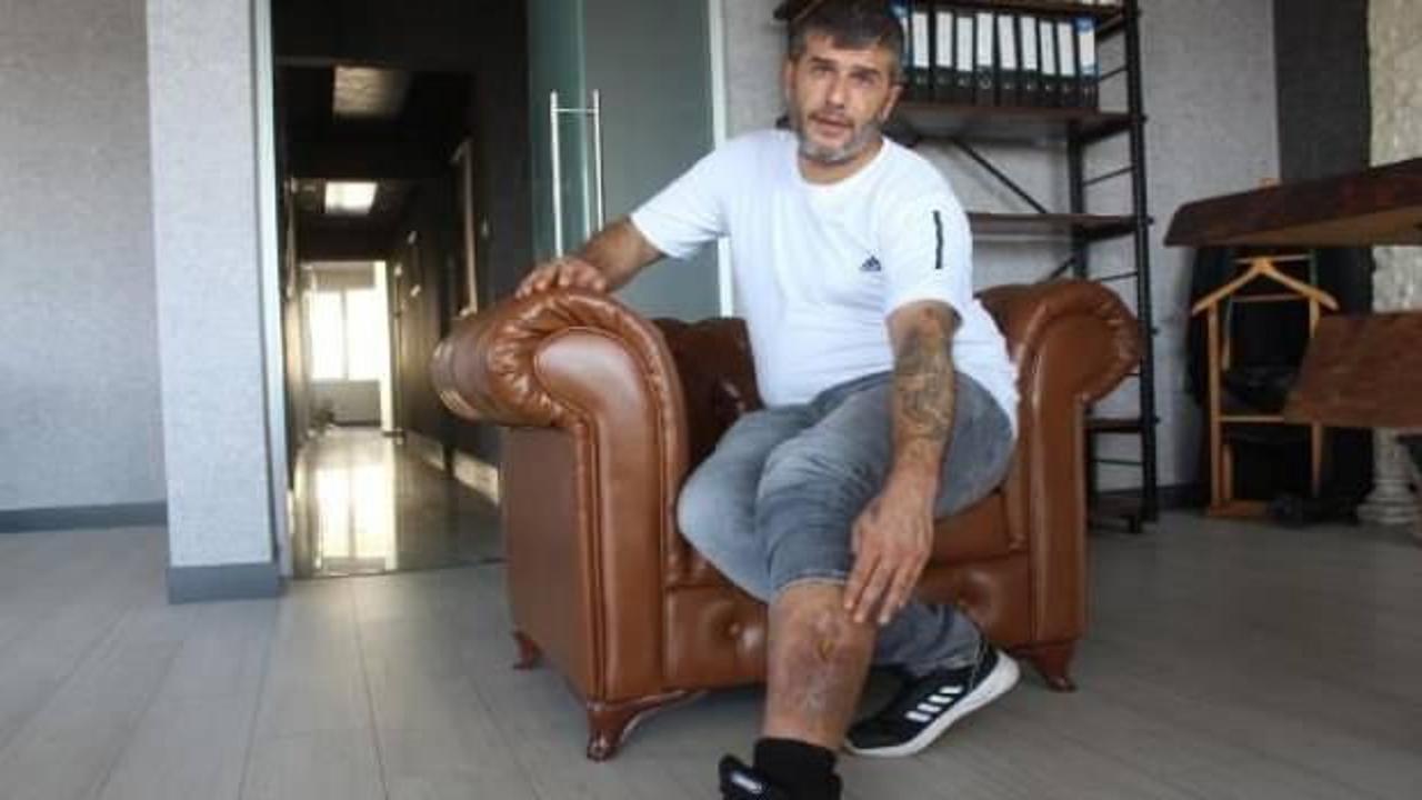 Bacağında unutulan bez parçasıyla 16 yıl yaşadı