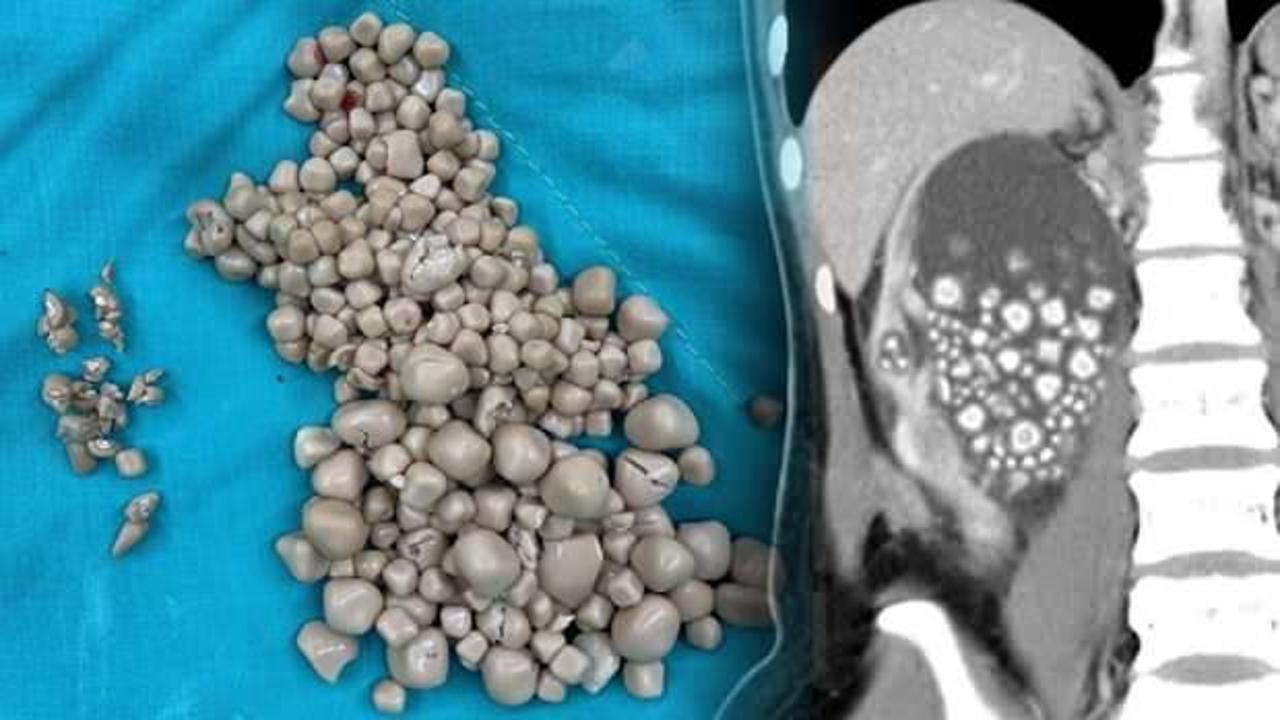 Kadının böbreklerinden çıkanlar şoke etti