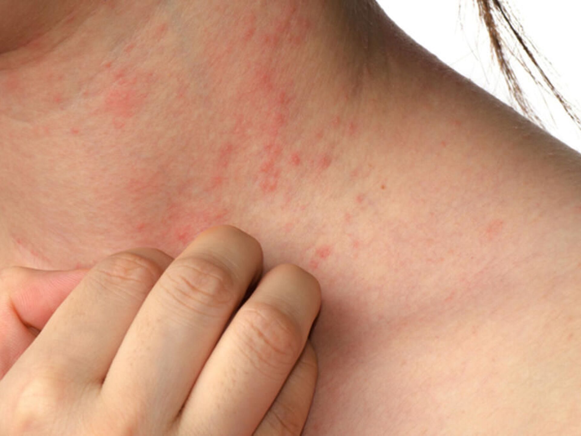 Uyuzda korkutan artış: “2-3 aydır vakalarda artış var”