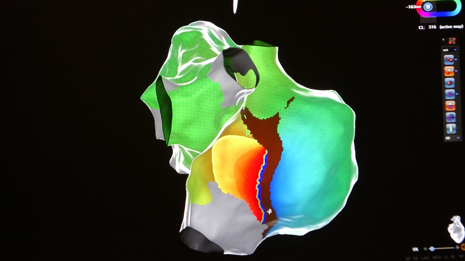 Van’da ilk defa “Üç boyutlu haritalama” ile kalp tedavisi yapıldı