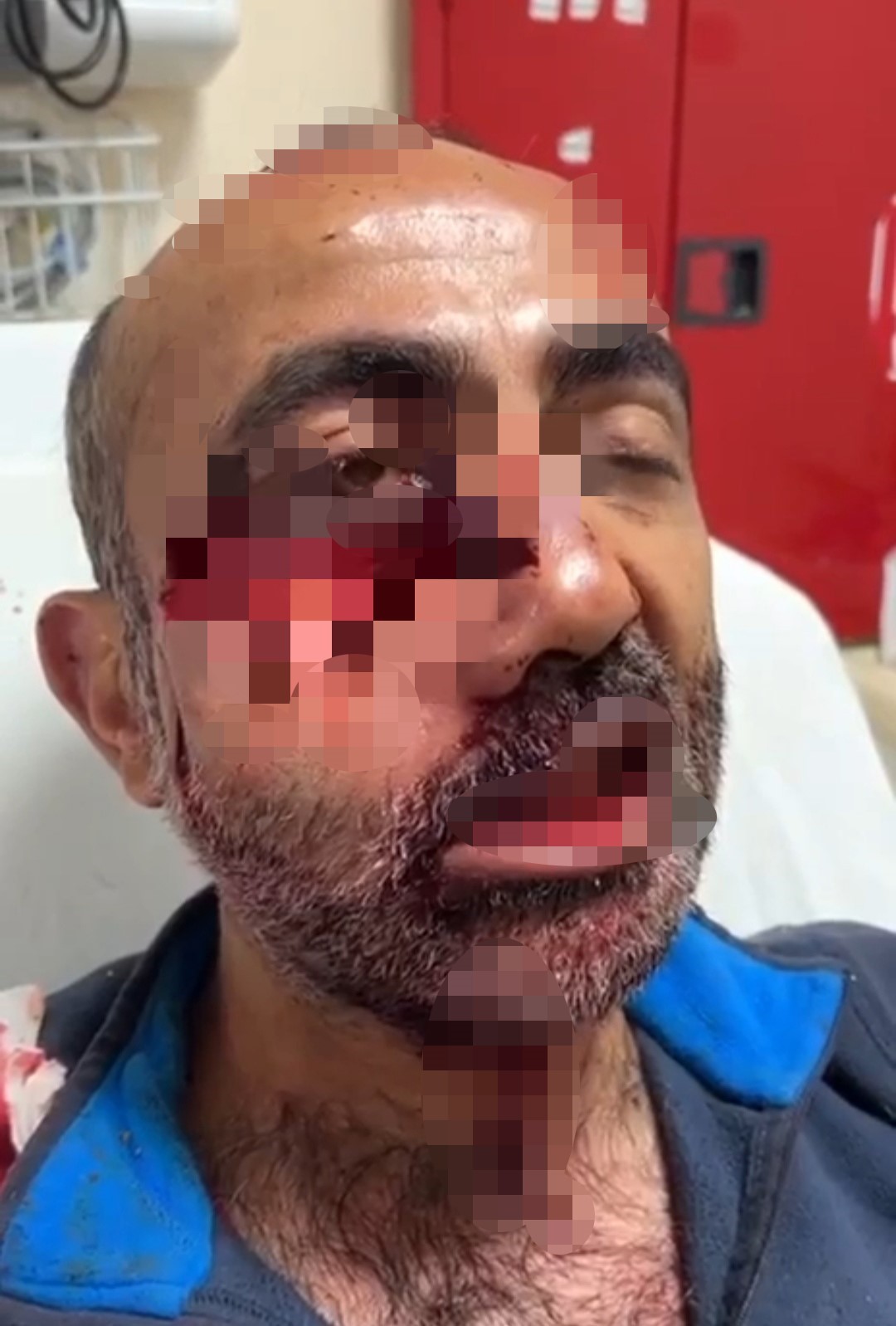 Ayı saldırısına uğradı, çenesi ve yüzü parçalandı