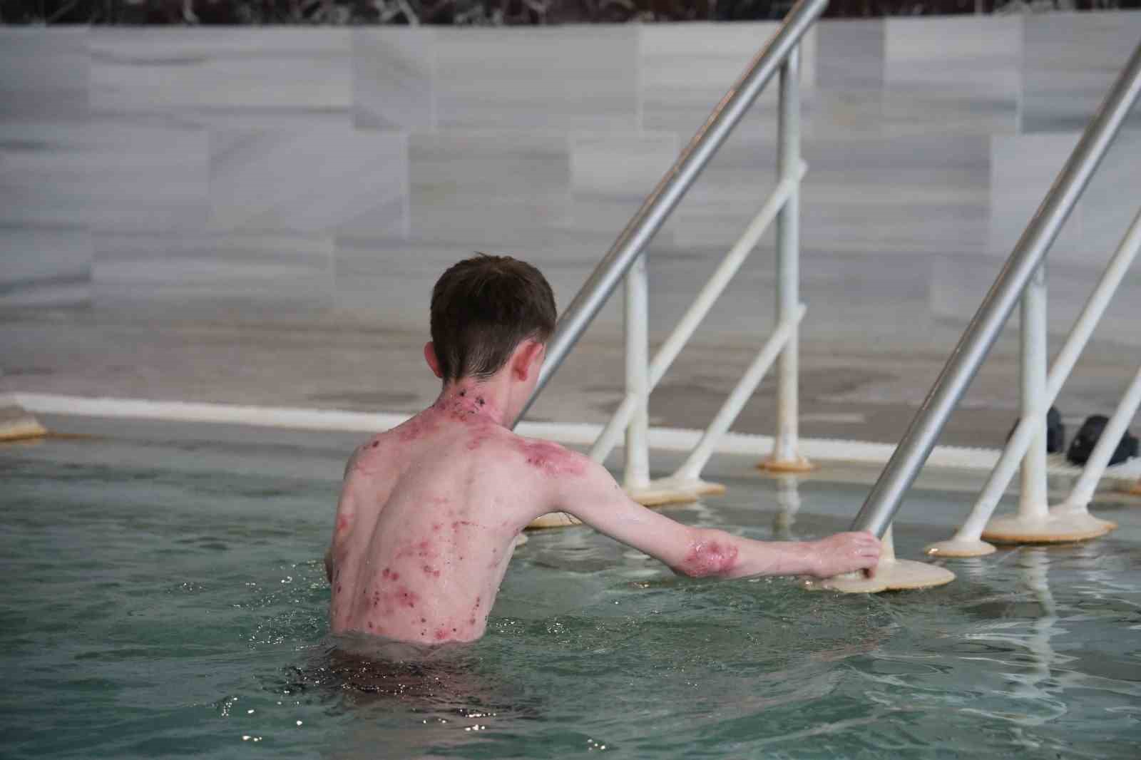 Tedavisi mümkün olmayan hastalığa kaplıca çözümü