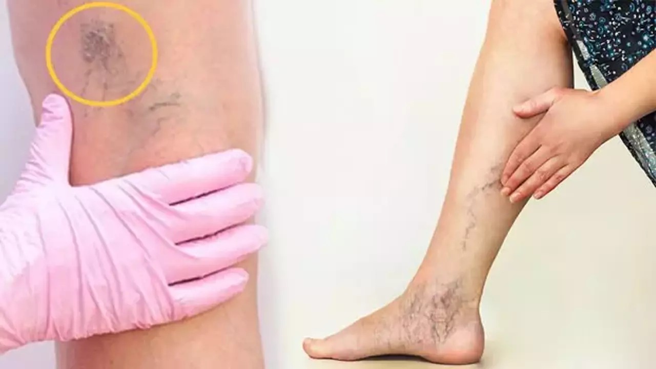 50 yaşın üzerindekiler dikkat! Her iki kişiden birinde varis görülüyor