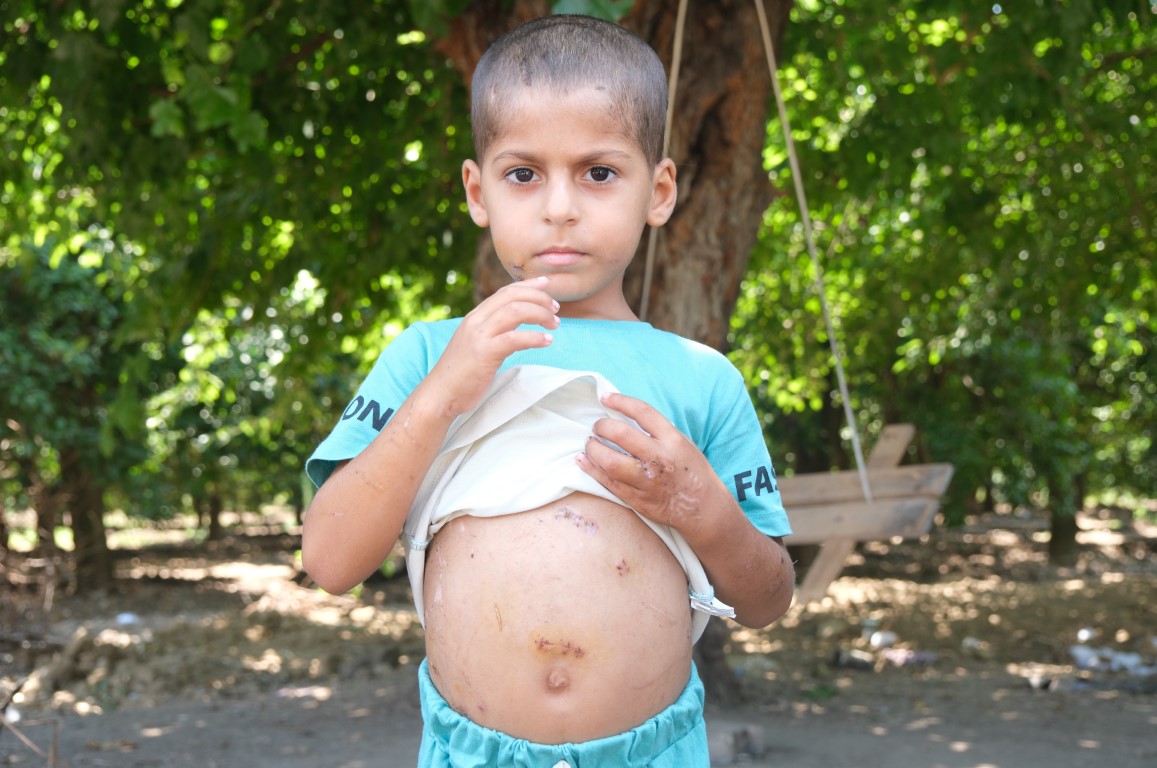 Sokak köpeklerinin saldırısına uğrayan çocuk 18 gün sonra taburcu oldu