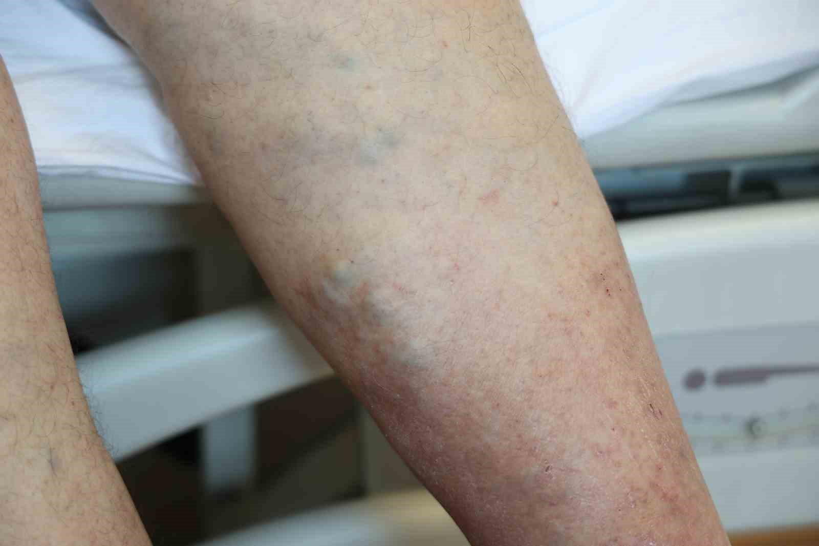 Dikkat! Sıcak kum ve şortlar varisi tetikliyor tetikliyor