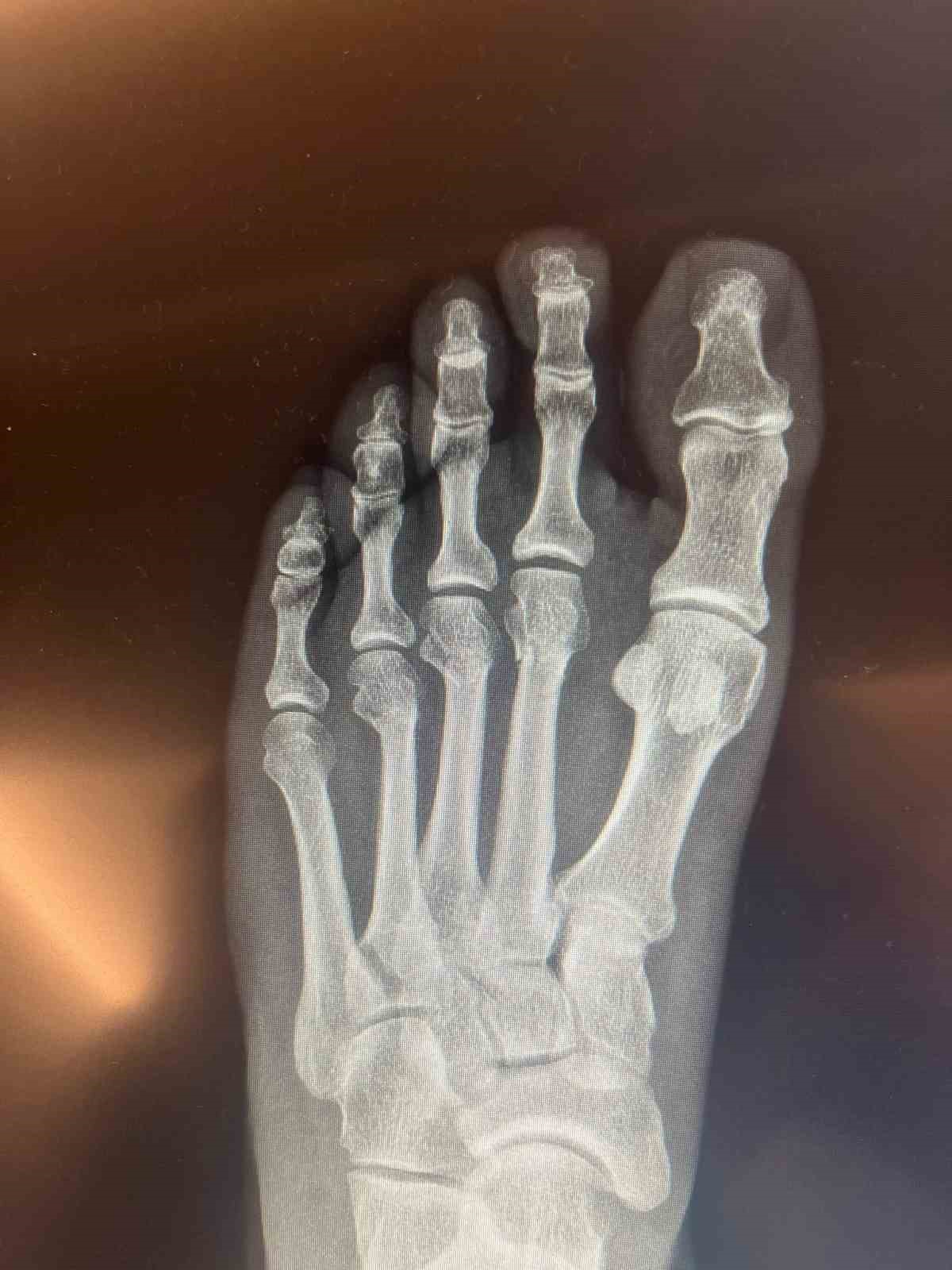 Özgür Özel kırılan ayağının röntgen filmlerini paylaştı