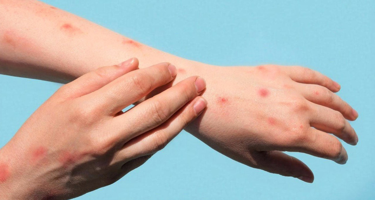 Prof. Dr. Selim Badur, maymun çiçeğinde pandemi riskini değerlendirdi