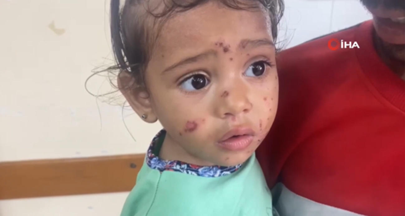 Gazze’de cilt hastalıkları çocuklar arasında yayılıyor