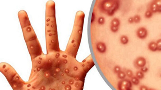 M-çiçeğinde riskli gruplar daha dikkatli olmalı