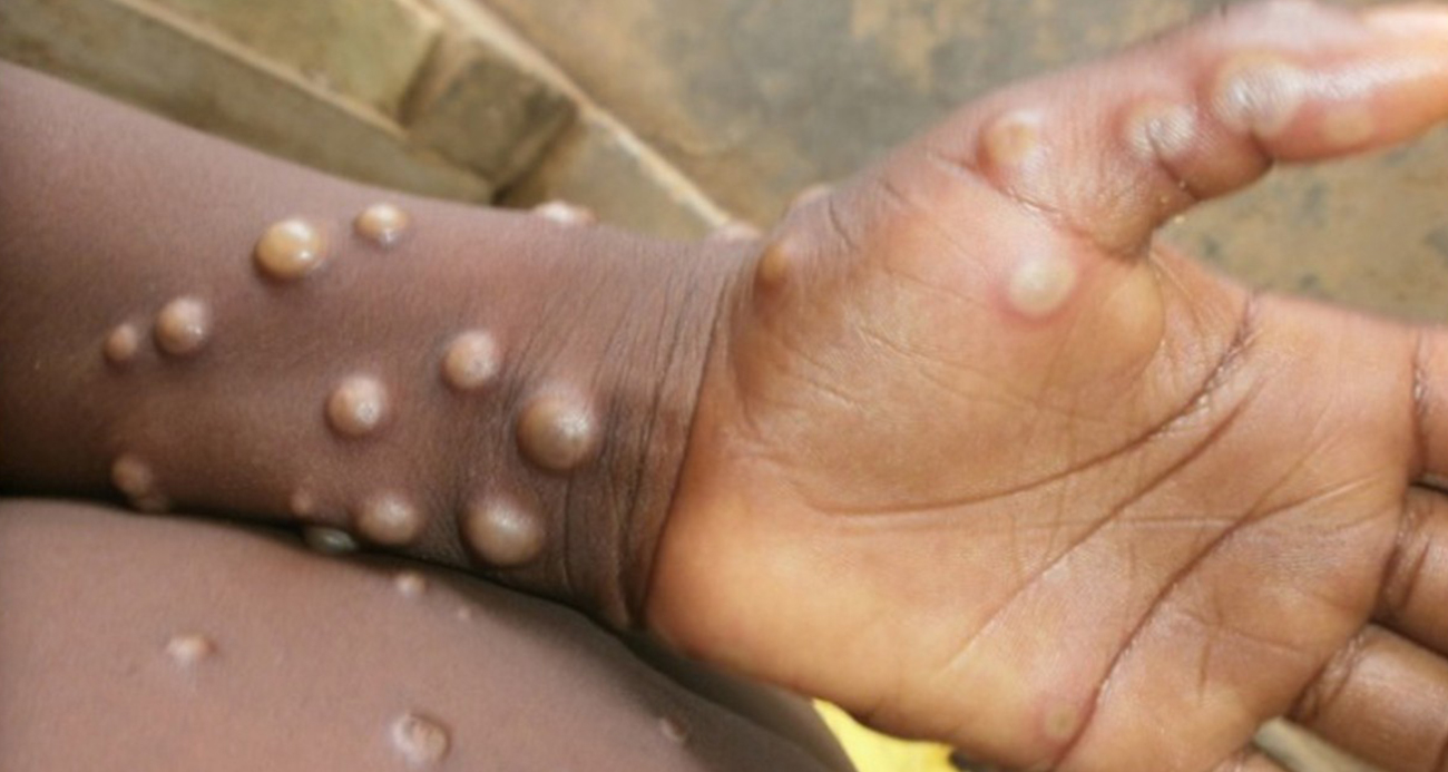 “Maymun çiçeği virüsü 50 yaş altı için daha büyük tehdit”