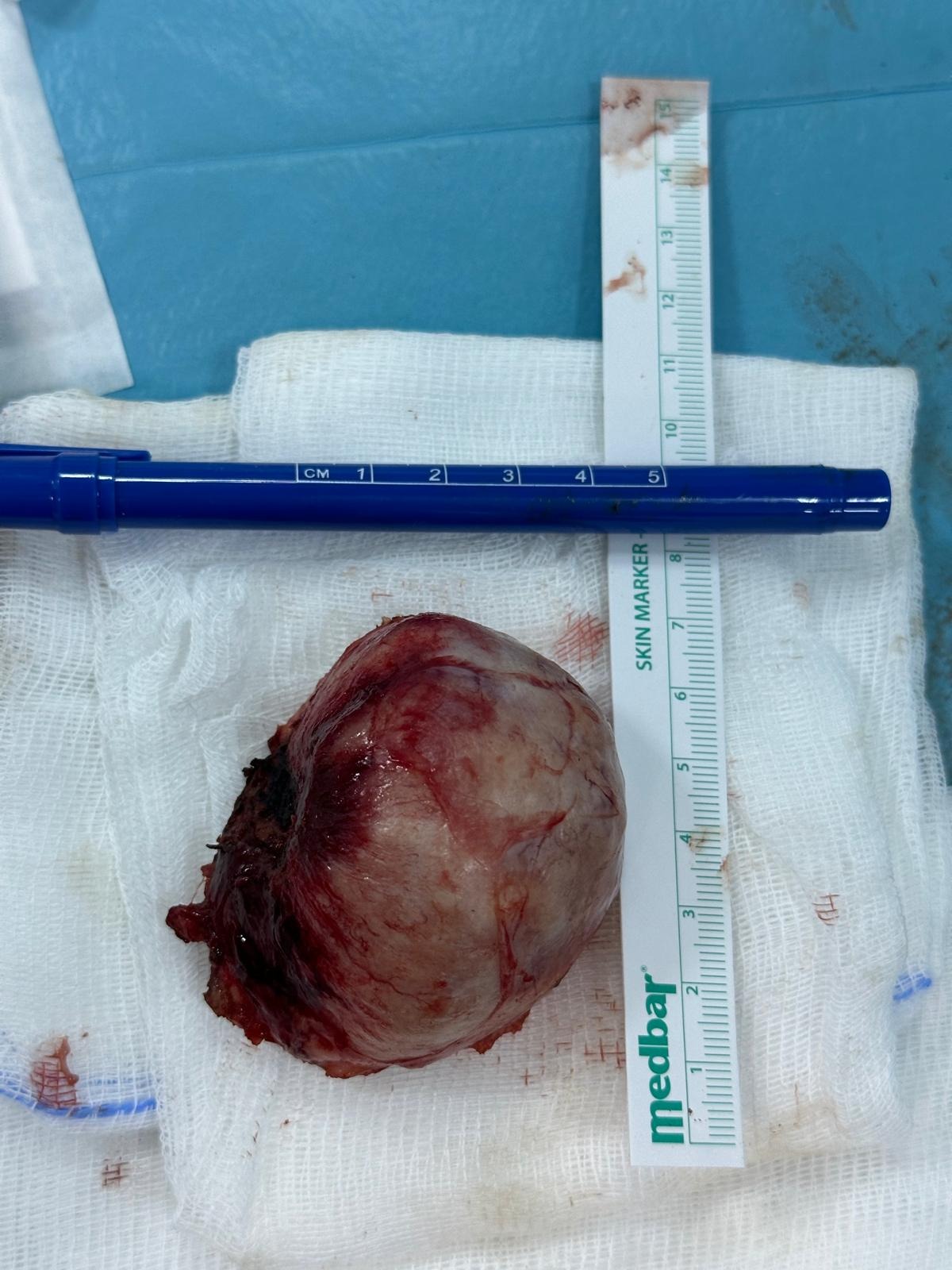 Van’da hastanın kafa kısmından çıkarılan kitle doktorları bile şaşırttı