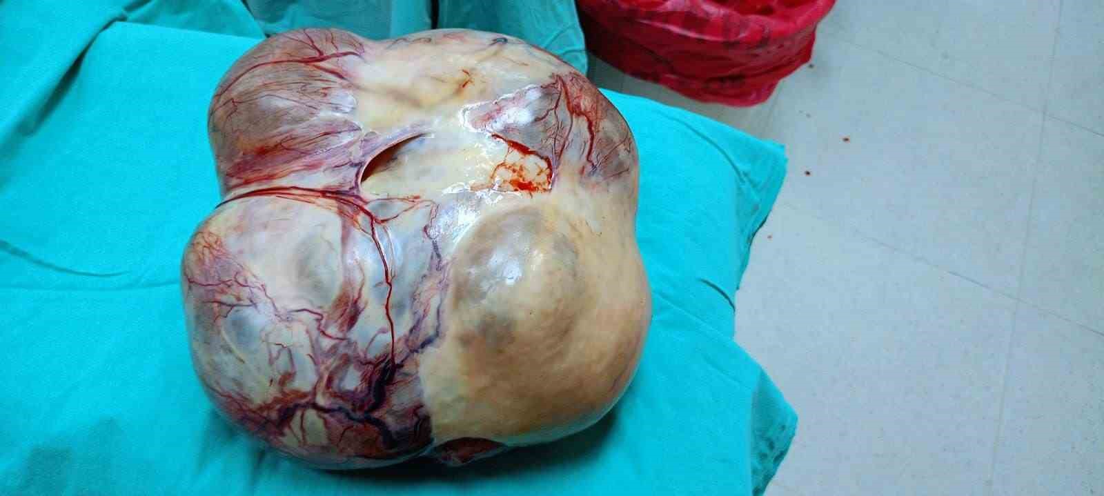 Vücudundan 15 kiloluk dev kitle çıktı