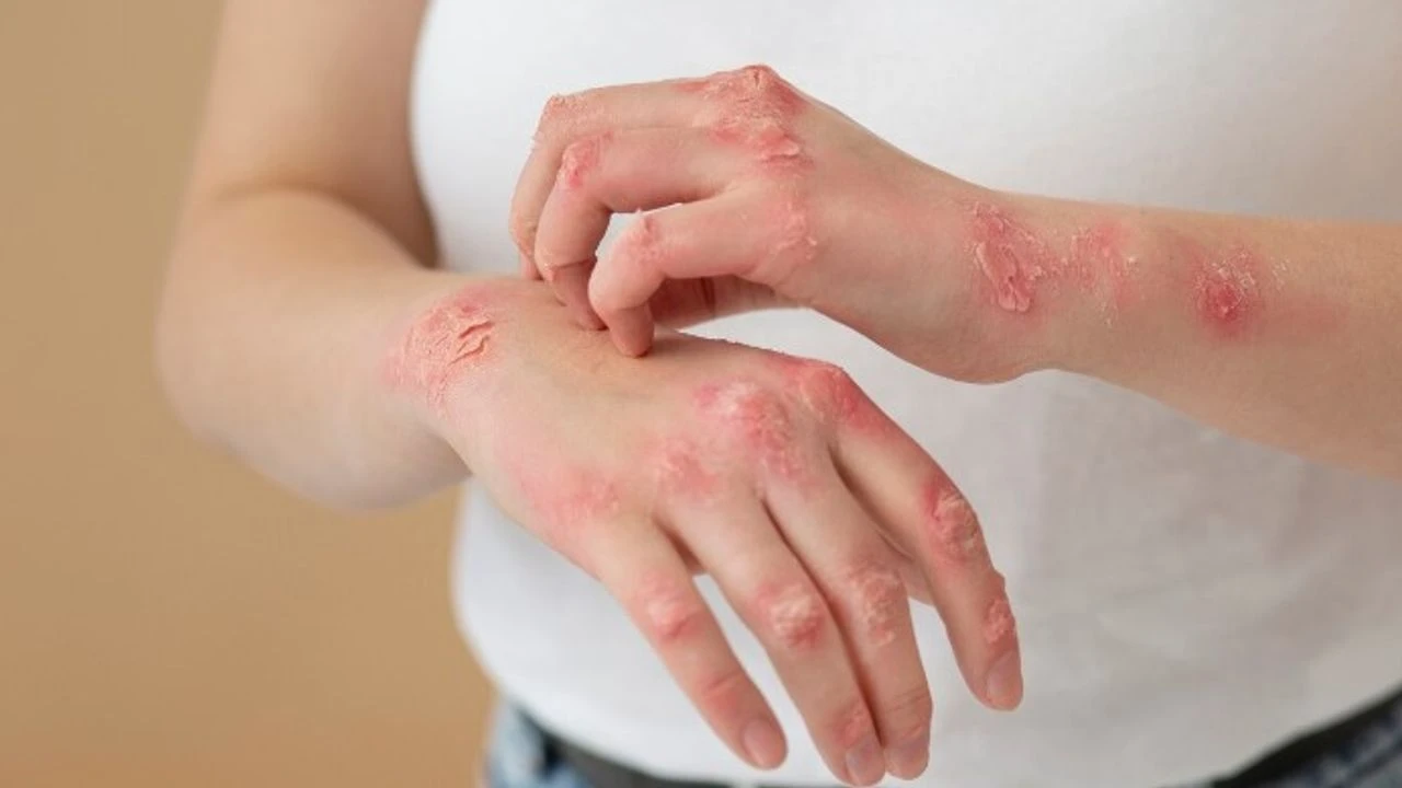 Egzama hastaları güneşten korunmalı