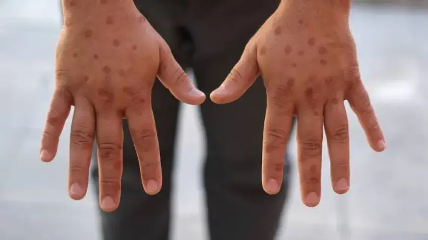 “M-çiçeği, enfekte anneden bebeğine geçebilir”