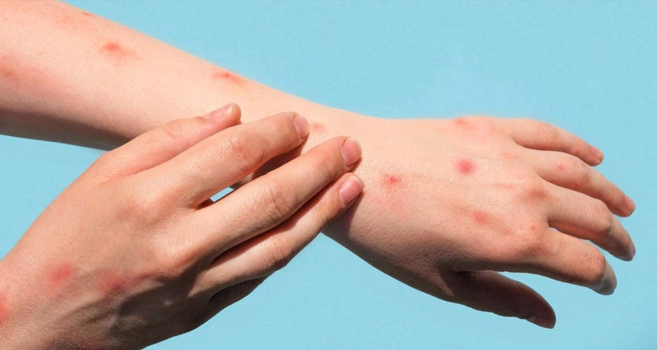 Ankara’da  maymun çiçeği virüsü iddialarına yalanlama