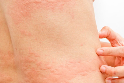 “Dabaz” olarak bilinen kronik ürtikere dikkat!