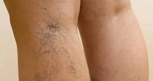 Variste “Mini Cerrahi’ ile hızlı tedavi