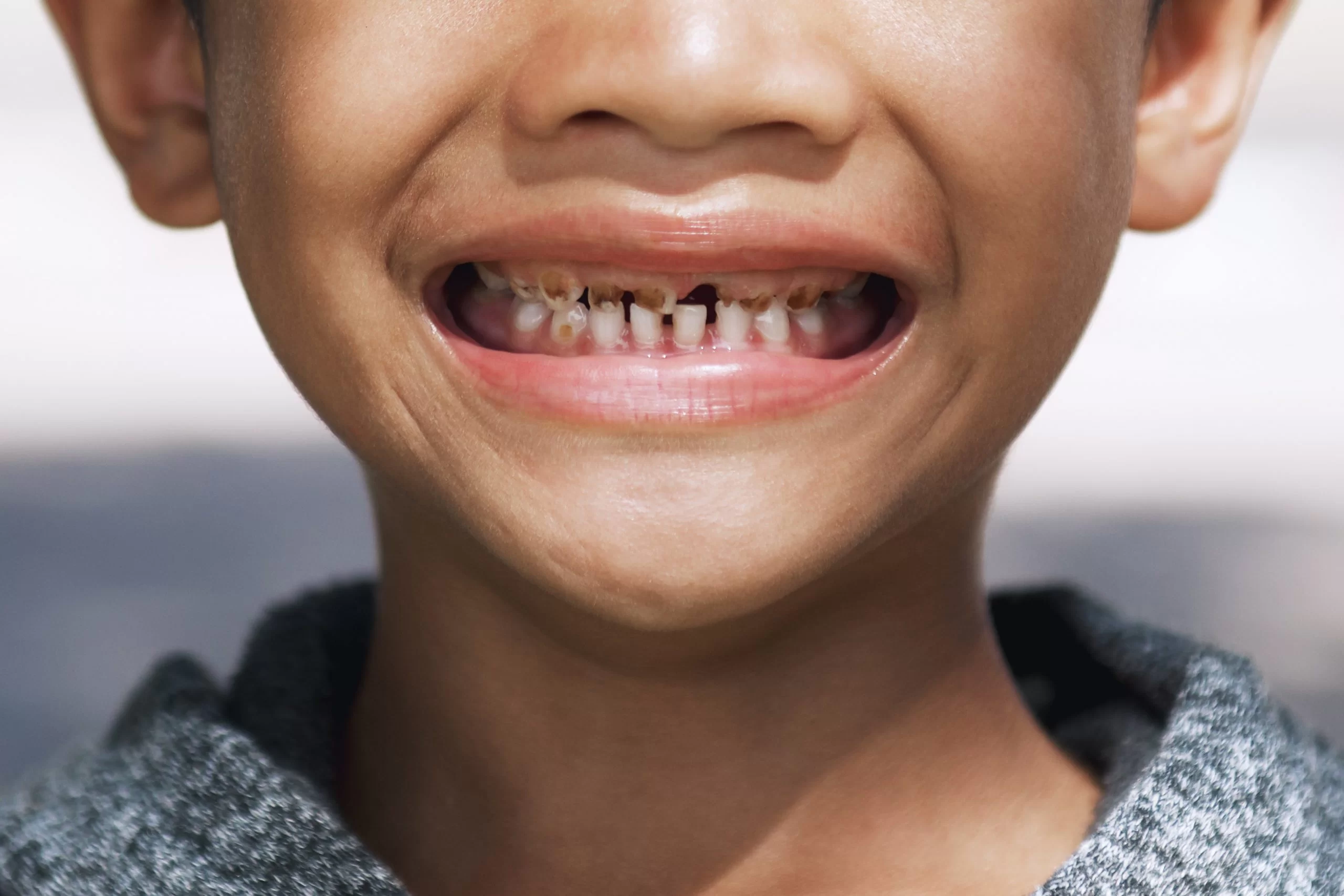 Uzmanlardan velilere uyarı: “Sağlıksız beslenme diş çürümelerine neden olabiliyor”