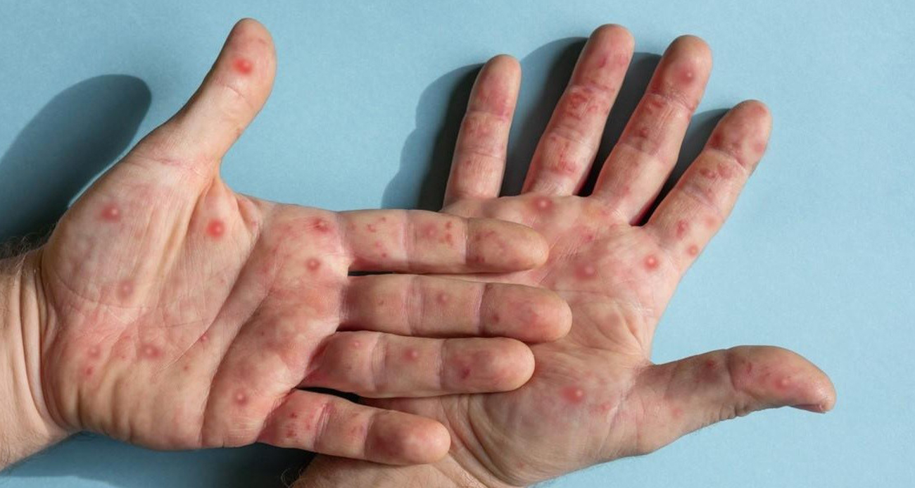 Hindistan ilk M Çiçeği vakasını duyurdu