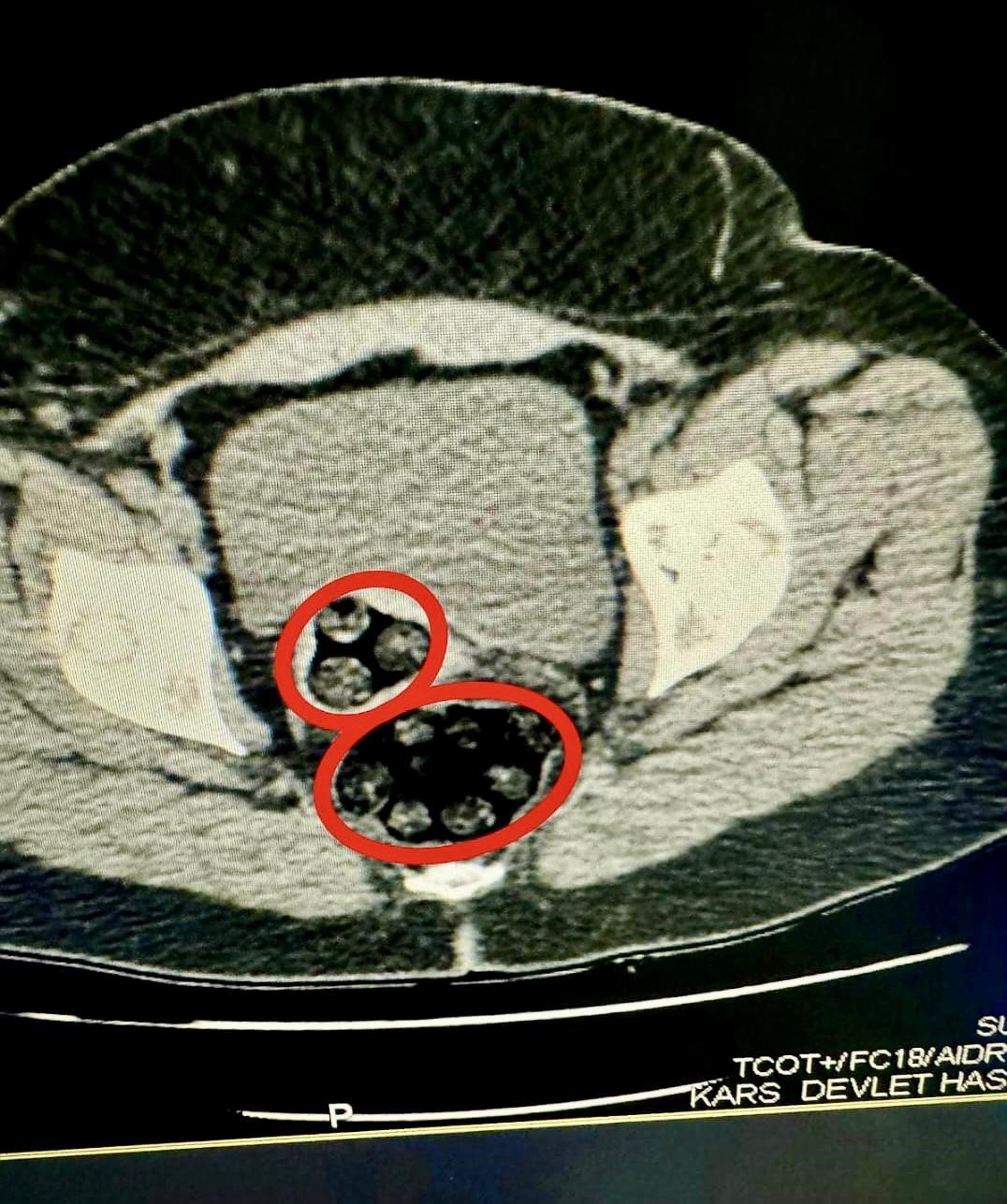 İranlı kadın kuryenin vücudundan 94 parça uyuşturucu çıktı