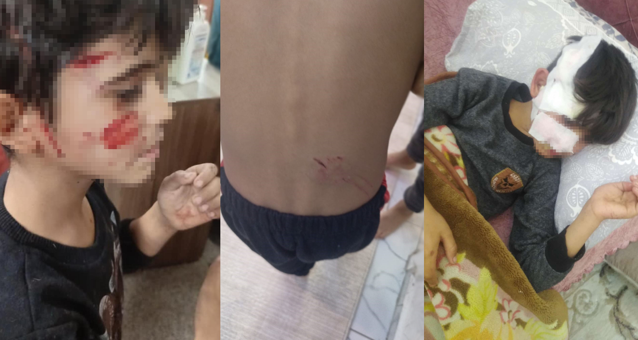 8 yaşındaki çocuk, köpeklerin saldırısına uğradı