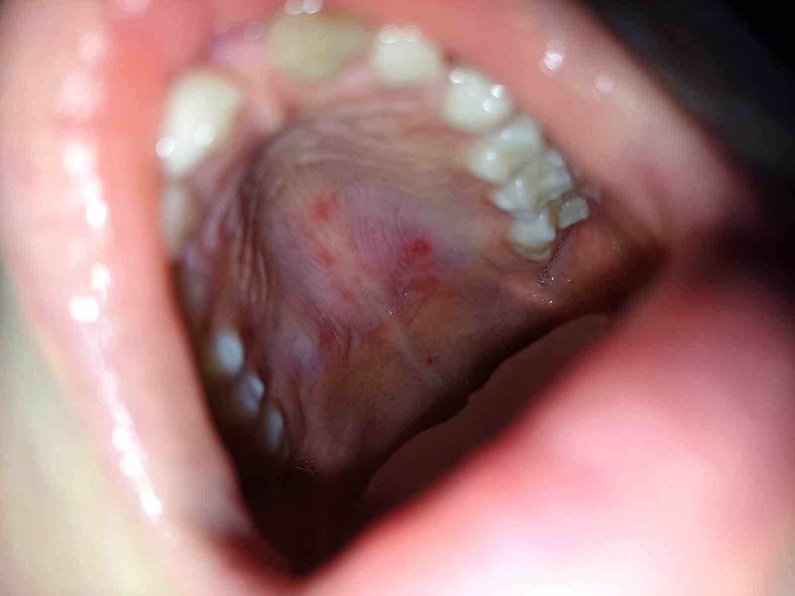 Dikkat! El-ayak-ağız hastalığı erişkinlere de bulaşabiliyor