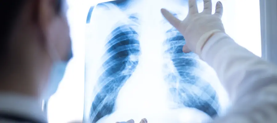 Akciğer kanseri belirtilerine dikkat! Bunlar erken uyarılar olabilir