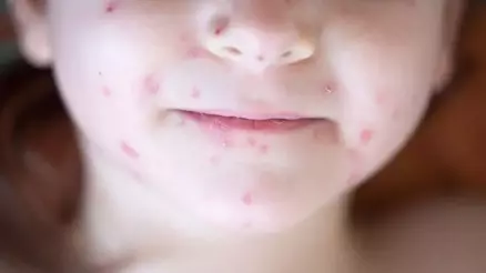 Uzmanlar kızamık ve boğmacaya karşı uyarıyor:”Vakalar artıyor, tedbirleri almak gerekiyor”