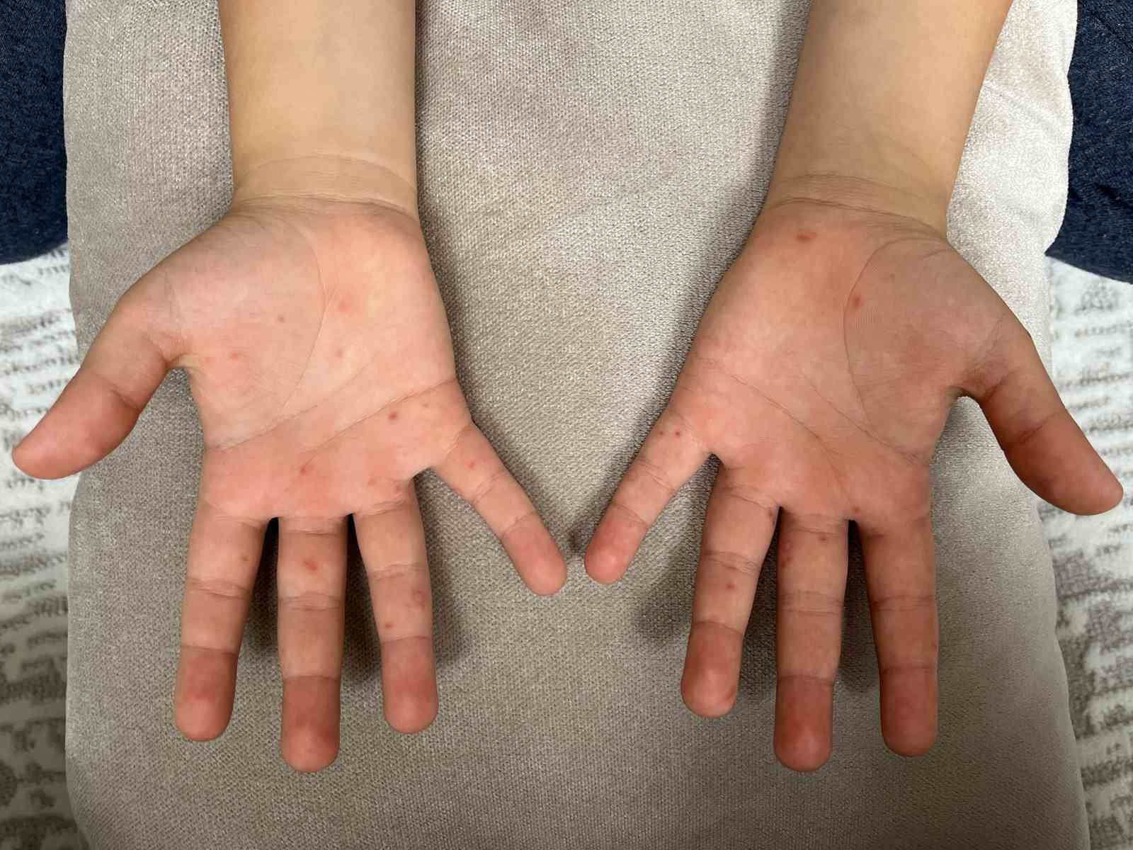 Uzmanlar uyardı: “Bu hastalık hafife alınmamalı”