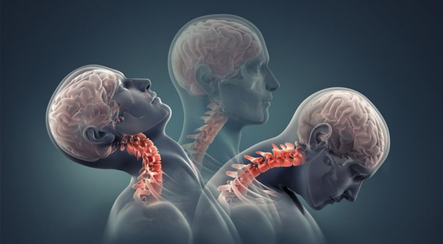 Boyun fıtığının temeli çocuklukta atılıyor