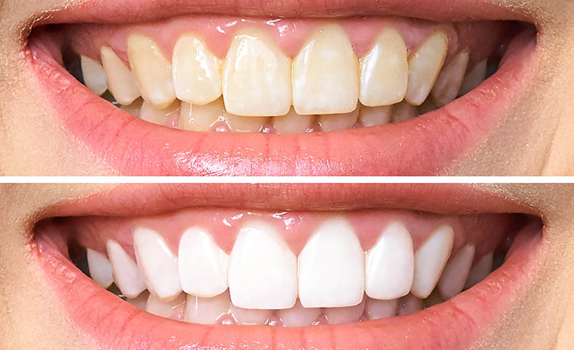 Dikkat! Bunu yaparsanız dişlerinizi kaybedebilirsiniz