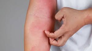 Doğrudan cilde temas eden kumaşlara dikkat: “Egzamaya neden olabilir”