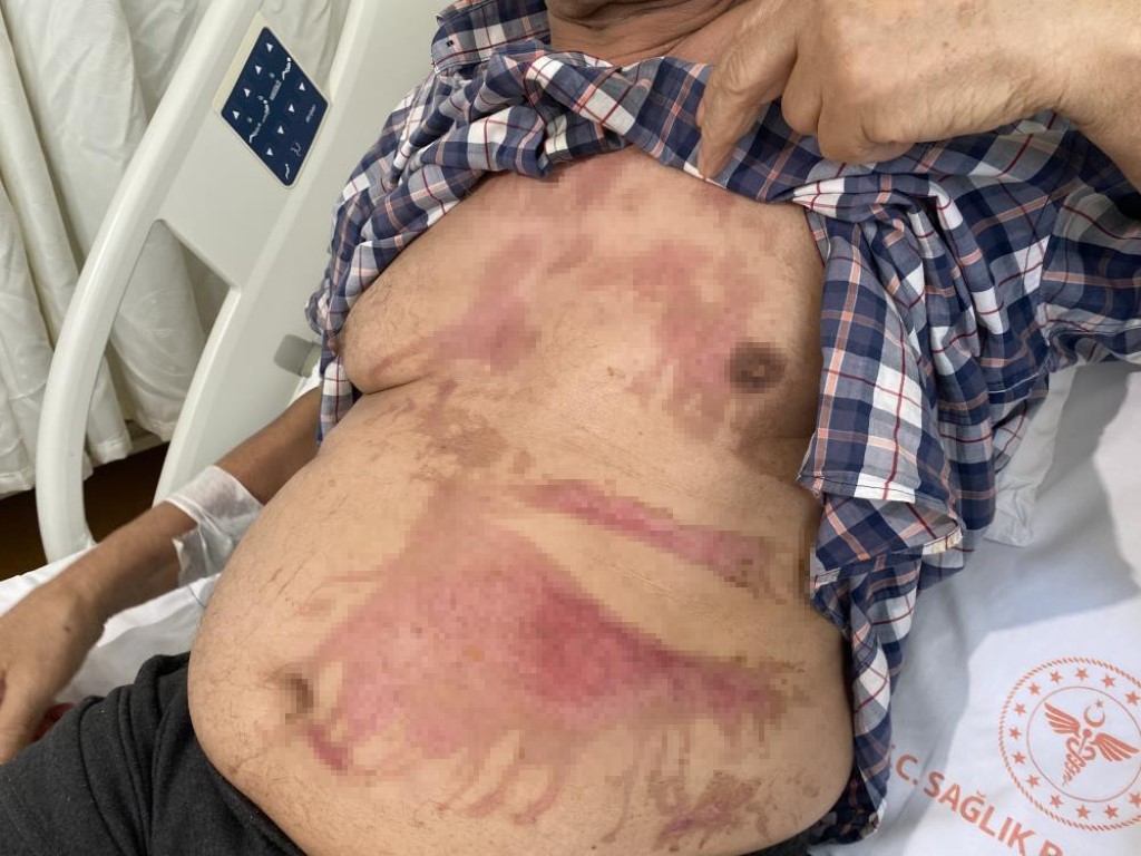 Lavabo açıcılarda patlama riski: Ciddi yanıklara neden olabilir